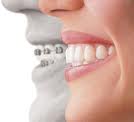 veneers for teeth